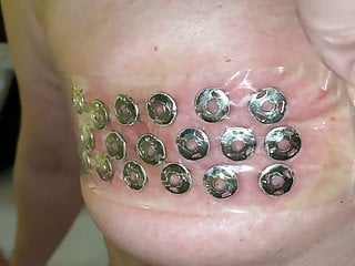 Removal of thumbtacks from the tits